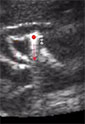 ultrasound image with kidney stone and path marked in red